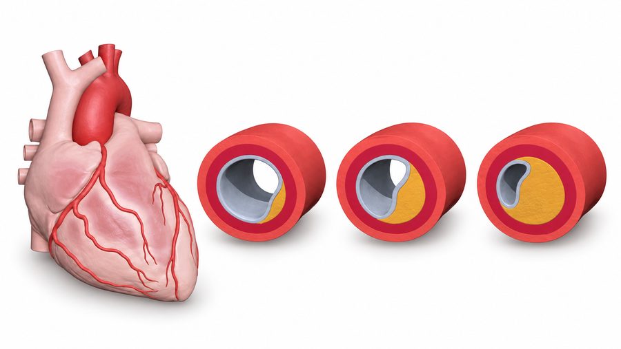 Educational heart anatomy and artery cross-sections showing different amounts of plaque